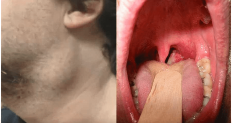 Cancer de garganta fotos - Psiquismo