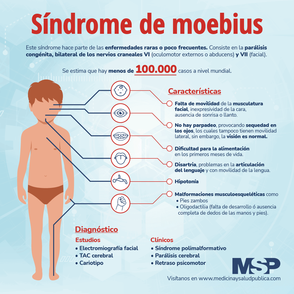 sindrome de moebius